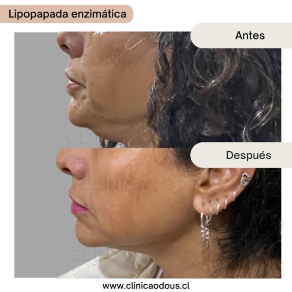 Lipopapada Enzimática - Imagen 2