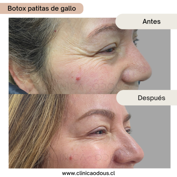 Toxina Botulínica 3 zonas - Imagen 4