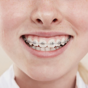 Ortodoncia - Frenillos o Brackets
