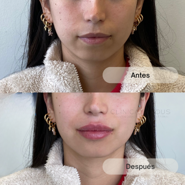 Perfilado y Relleno Labial - Imagen 2
