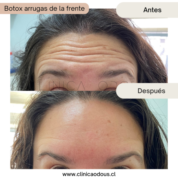 Toxina Botulínica 3 zonas - Imagen 2