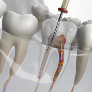 Endodoncia