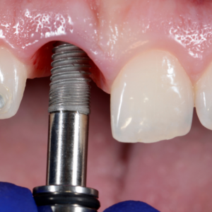 Implante Dental