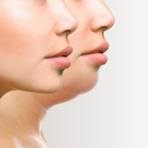 Lipopapada Enzimática