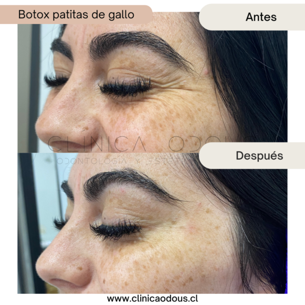 Toxina Botulínica 3 zonas - Imagen 5