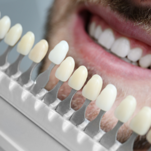 Blanqueamiento Dental