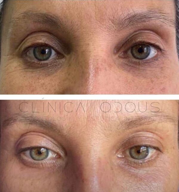 Blefaroplasma - Imagen 2